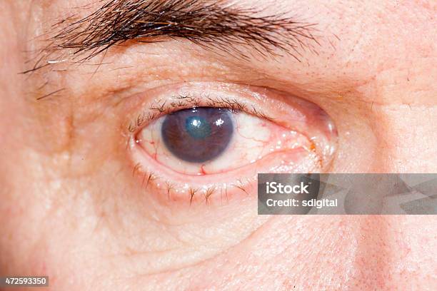 Eye Disease Infecting A Brown Eye Stock Photo - Download Image Now - Cataract, Eye, Eye Exam