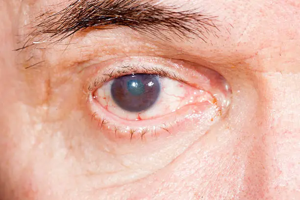 close up of the senile cataract during eye examination,