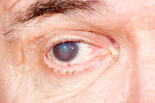 close up of the senile cataract during eye examination,