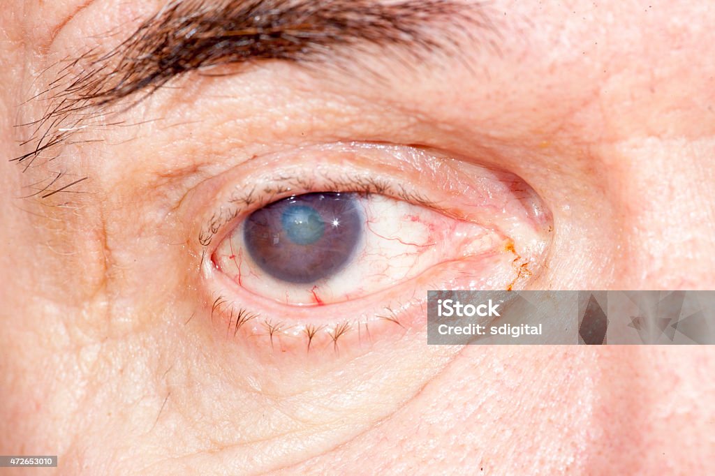 eye disease close up of the senile cataract during eye examination, Cataract Stock Photo