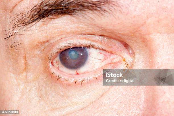 Eye Disease Stock Photo - Download Image Now - Cataract, Eye, Senior Adult