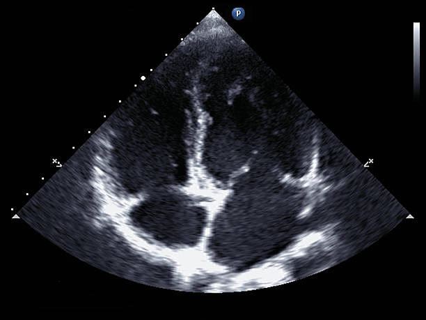 échocardiogramme - septum interventriculaire photos et images de collection