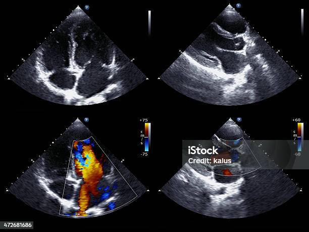 Echocardiography Stock Photo - Download Image Now - Echocardiogram, Ultrasound, Doppler