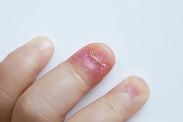 Paronychia, swollen finger with fingernail bed inflammation due to bacterial infection on a toddlers hand.