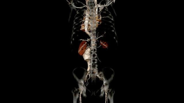 Computerized Tomography Angiogram