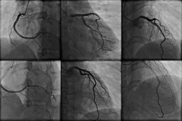 sinus angiography - human heart heart attack x ray image chest stock-fotos und bilder