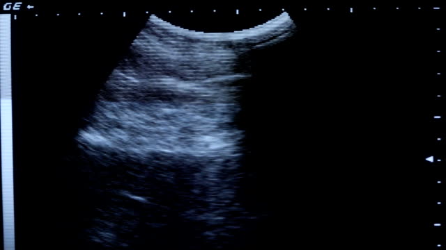 Ultrasound exam of abdomen