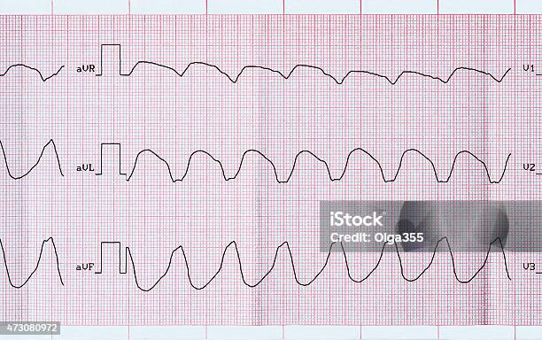 Ecg Tape With Paroxysmal Ventricular Tachycardia Stock Photo - Download Image Now - Electrocardiography, Tachycardia, Heart Ventricle