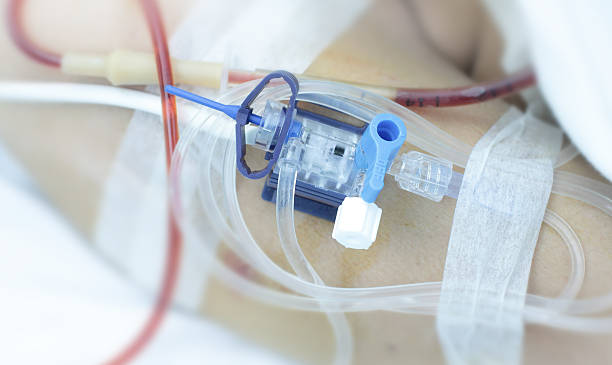 invasive sistema para el control de la presión arterial.   tubos en los hombros del paciente. - expendable fotografías e imágenes de stock