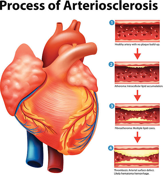 proces stwardnienie tętnic - human artery cholesterol atherosclerosis human heart stock illustrations