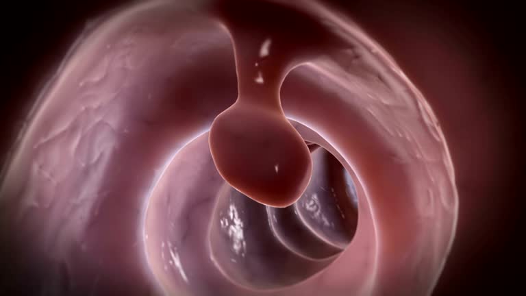 260+ Colorectal Cancer Stock Videos and Royalty-Free Footage - iStock | Colon cancer screening, Colonoscopy, Colon