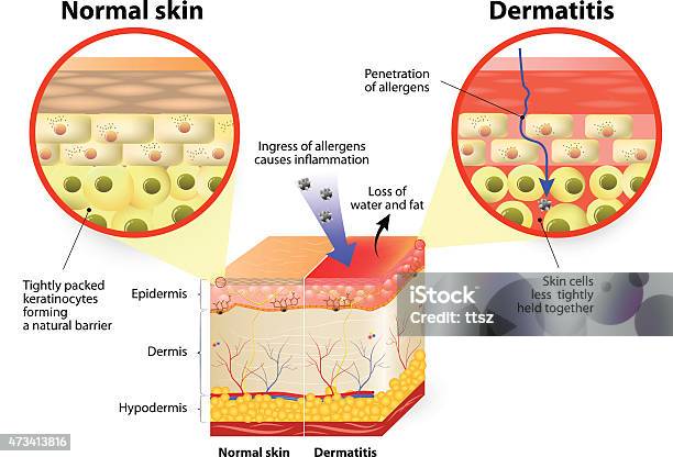 Ilustración de Dermatitis O Eccema y más Vectores Libres de Derechos de Dermatitis - Dermatitis, Eczema, Célula queratinizada