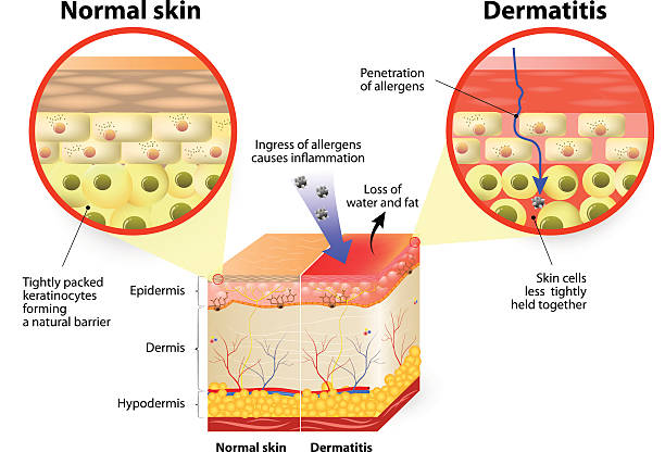 dermatitis or eczema Skin showing changes due to dermatitis. labeled tinea stock illustrations