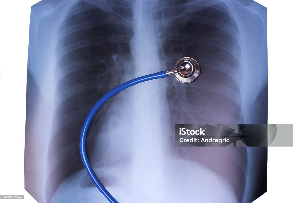 Raio-X de pulmões - Foto de stock de 2015 royalty-free