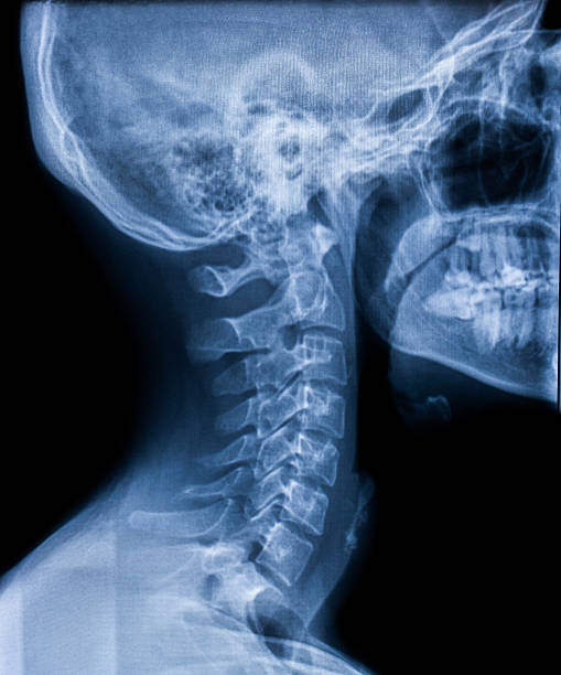 X-ray of the neck X-ray of neck injury a young man on a black background cervical vertebrae photos stock pictures, royalty-free photos & images