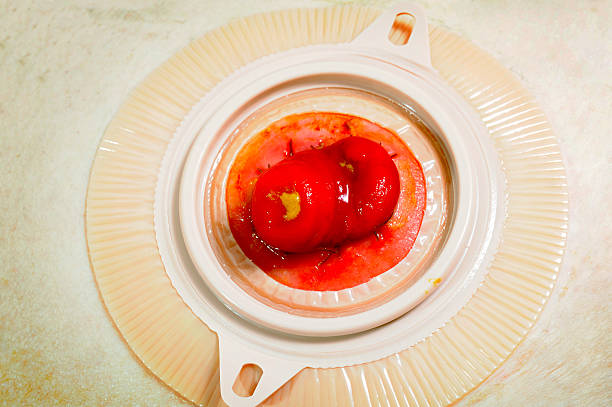 File:Blausen 0247 Colostomy.png - Wikipedia