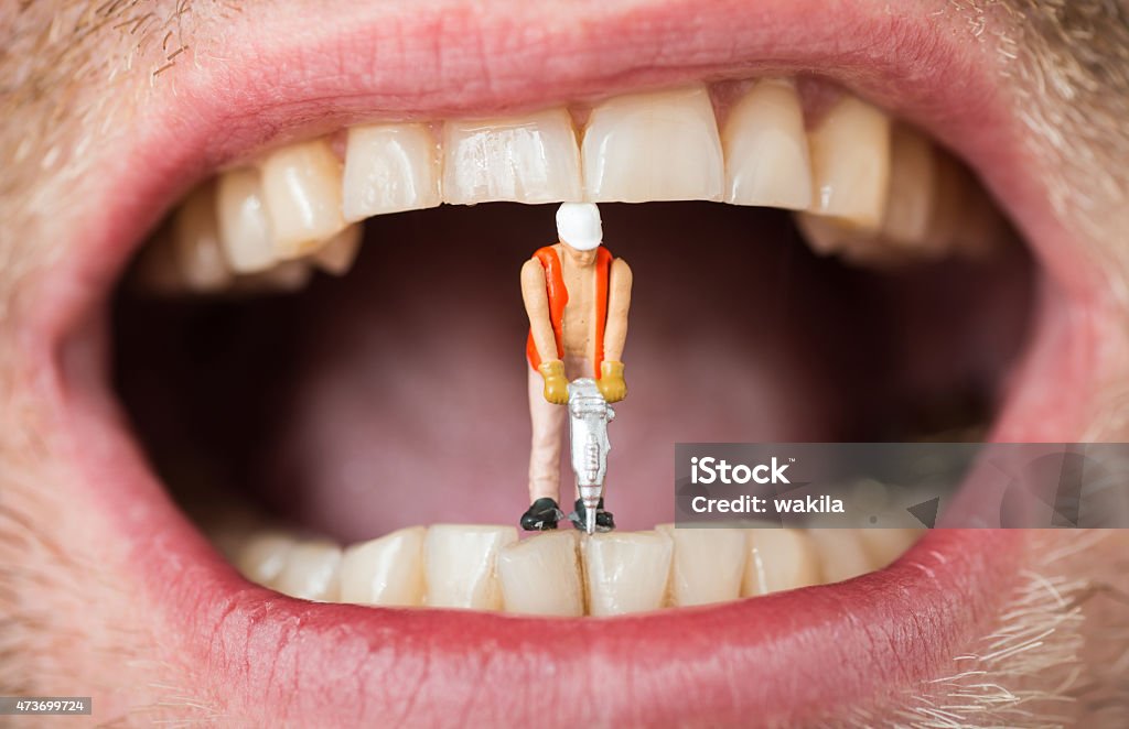 dental filling caries abstract with mini construction worker on teeth dental filling caries abstract with mini construction worker Dental Calculus Stock Photo