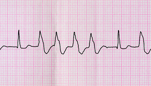 istock Tape ECG with group ventricular extrasystoles 473712172