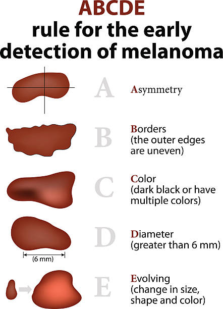 The ABCD rules of Skin Cancer ABCDE Rule for the early detection of Melanoma melanoma stock illustrations