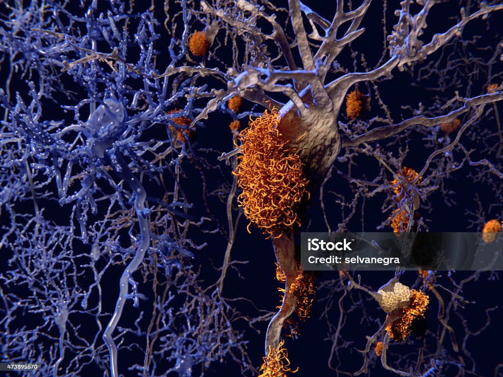 Alzheimer disease, neurons with amyloid plaques Neurons with amyloid plaques (right side) compared to healthy neurons (left). Amyloid plaques accumulate outside neurons. Amyloid plaques are characteristic features of Alzheimer's disease. They lead to a degeneration of the affected neurons, that are destroyed through the activity of microglia cells. Alzheimer's Disease Stock Photo