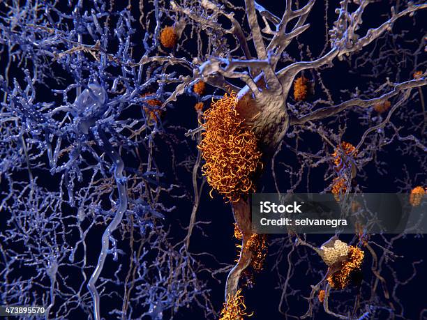 Alzheimer Disease Neurons With Amyloid Plaques Stock Photo - Download Image Now - Alzheimer's Disease, Amyloid, Nerve Cell