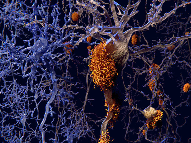 alzheimer disease, neurons with amyloid plaques - amyloid bildbanksfoton och bilder