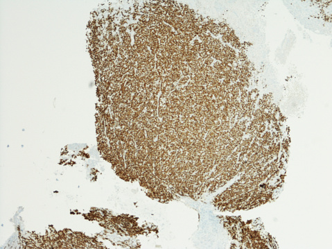 adenocarcinoma de esófago Distal photo