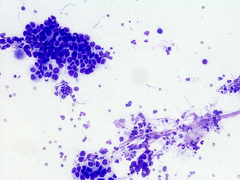 adenocarcinoma de esófago Distal photo