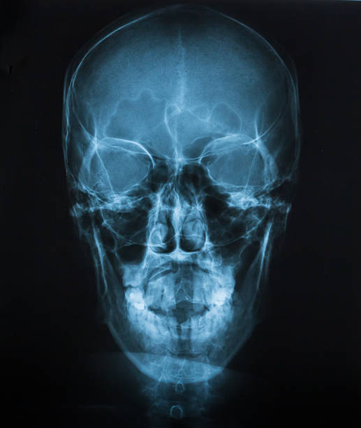 istock X-RAY film of skull bone,AP view 474059164