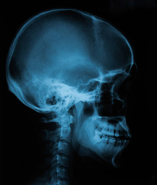 rentgenový film z lebky kosti,boční pohled - lebka člověka fotky - stock snímky, obrázky a fotky
