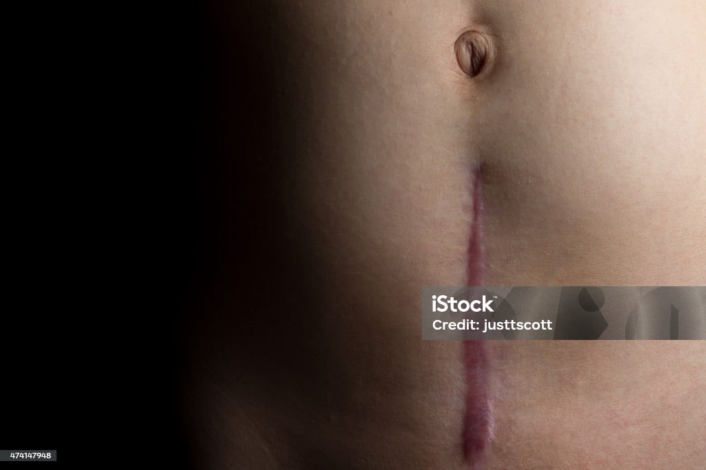 Recovering C-Section Scar A recovering scar from a c-section operation dramatically faded to black.A recovering scar from a c-section operation. Caesarean Section Stock Photo