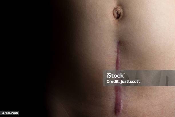 Recovering Csection Scar Stock Photo - Download Image Now - Caesarean Section, Scar, The Human Body
