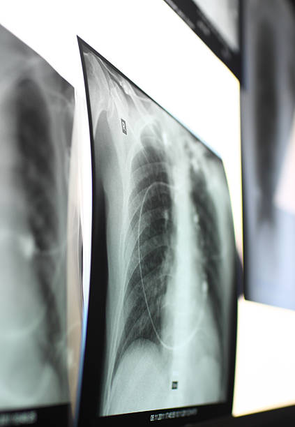 istock X-ray of lungs 474151152