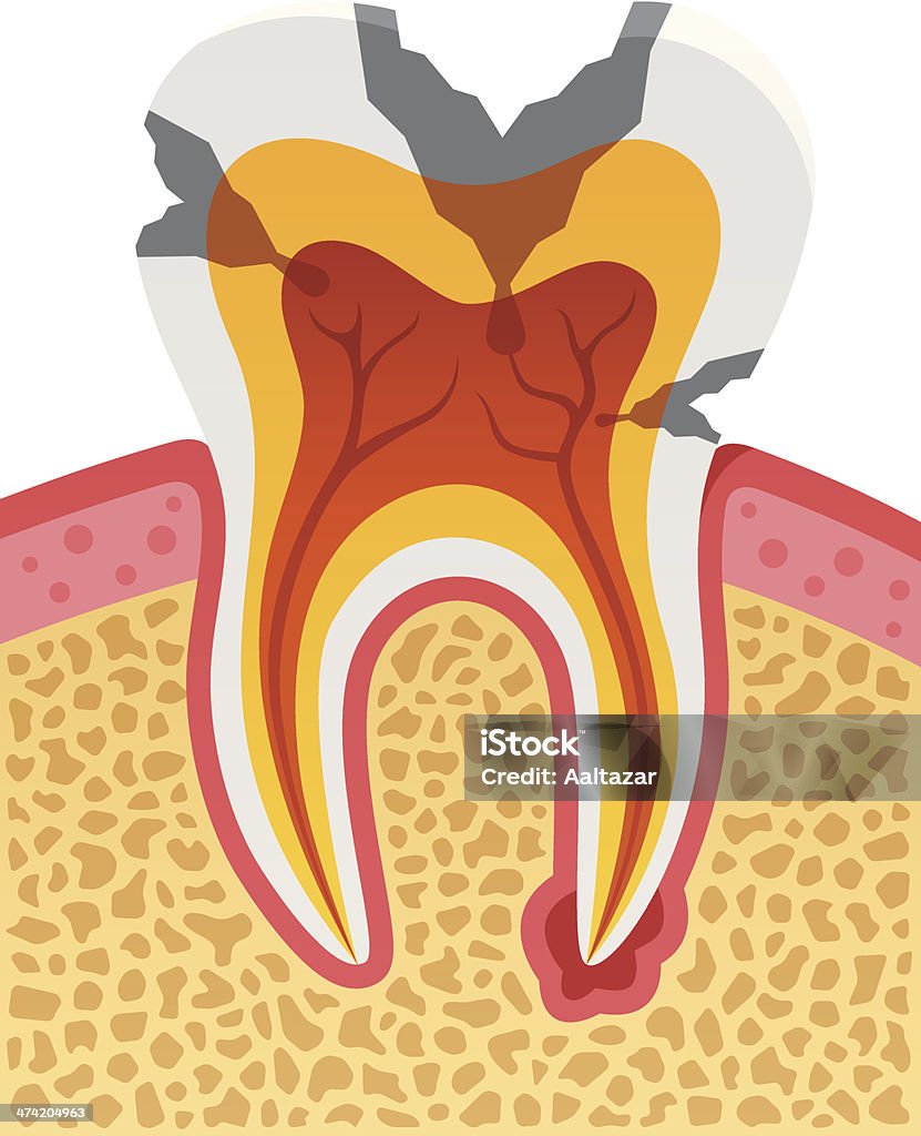 Carie dentaire Types - clipart vectoriel de Abscès libre de droits