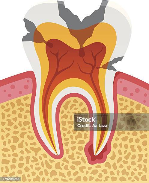 Tipi Di Carie Dentale - Immagini vettoriali stock e altre immagini di Ascesso - Ascesso, Ambulatorio dentistico, Anatomia umana