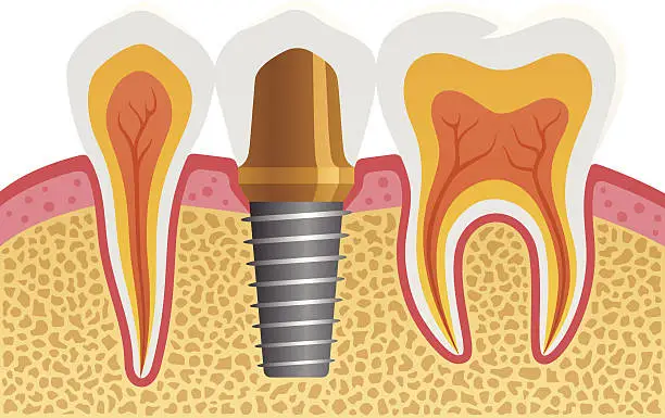 Vector illustration of Dental Implant