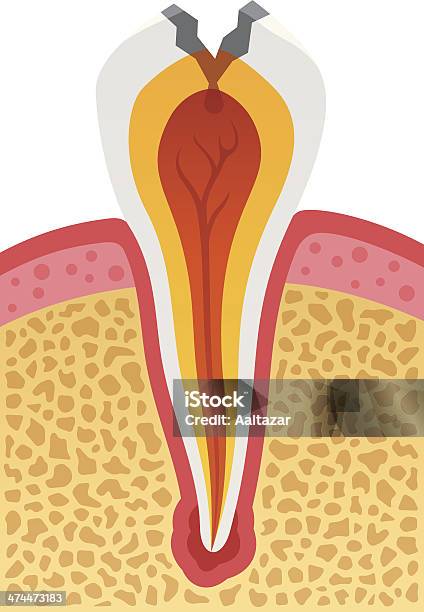 Ilustración de Carie Dental y más Vectores Libres de Derechos de Anatomía - Anatomía, Vista de frente, Absceso