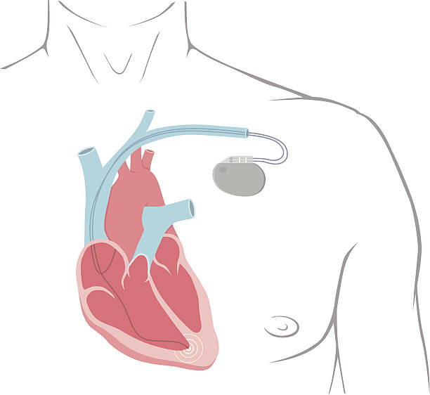 박동조율기 - pacemaker torso chest male stock illustrations