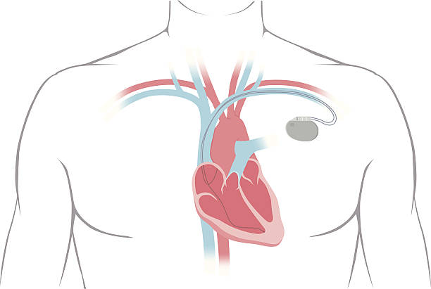 herzschrittmacher-diagramm - electrode healthcare and medicine medicine health care stock-grafiken, -clipart, -cartoons und -symbole