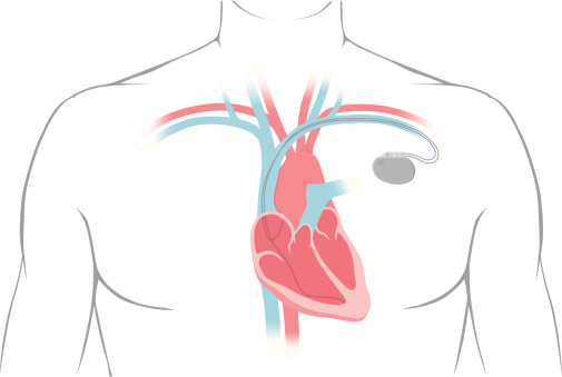 Cross section of a human heart with pacemaker fitted, showing the major arteries and veins. This is an EPS 10 vector illustration and includes a high resolution JPEG.