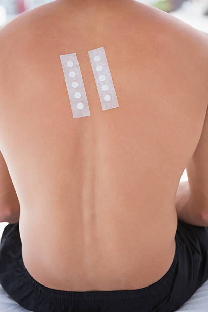 istock Patient with skin test in his back 474649426