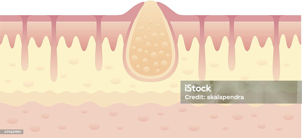 Pimple on skin Pimple on skin inside view Abscess stock vector