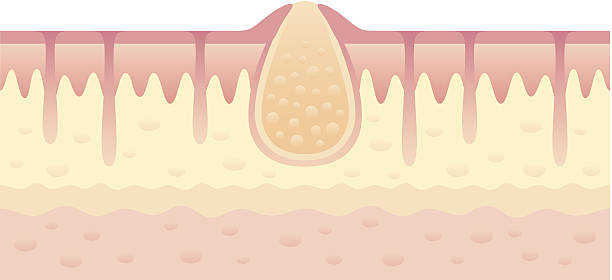 Pimple on skin Pimple on skin inside view abscess stock illustrations