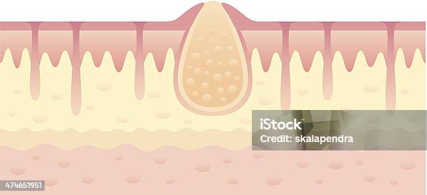Pimple On Skin Stock Illustration - Download Image Now - Abscess, Acne, Blob