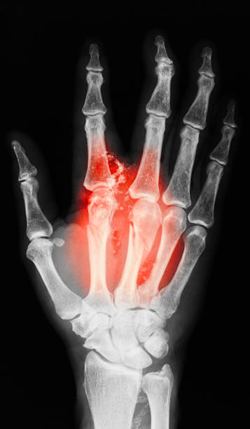 istock X-ray image of broken hand, PA view. 474700096