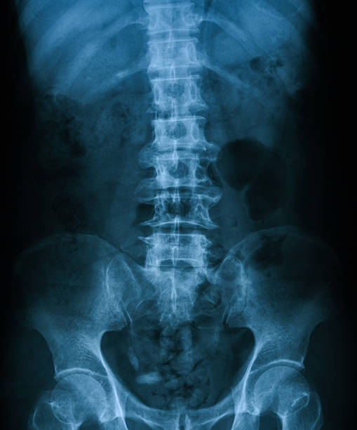 X-ray image of plain KUB. X-ray image of plain KUB, supine, show bladder stones. coccyx photos stock pictures, royalty-free photos & images
