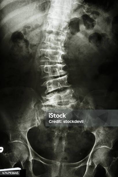 Scoliosis Stockfoto und mehr Bilder von Alter Erwachsener - Alter Erwachsener, Anatomie, Arzt