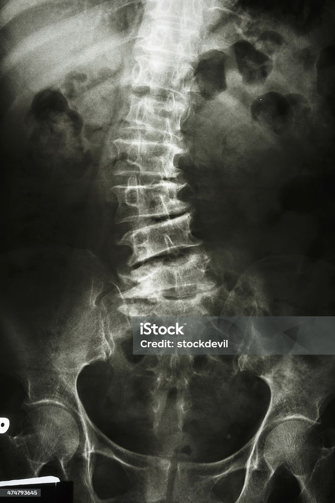 Escoliosis - Foto de stock de Adulto libre de derechos