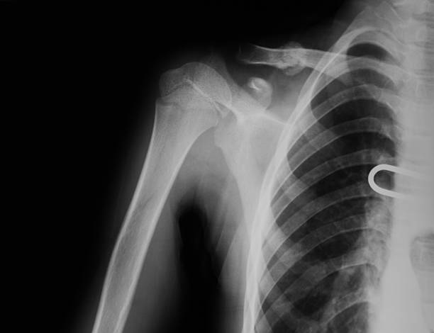istock X-ray image of broken clavicle, after treatment for 7 weeks. 474804228