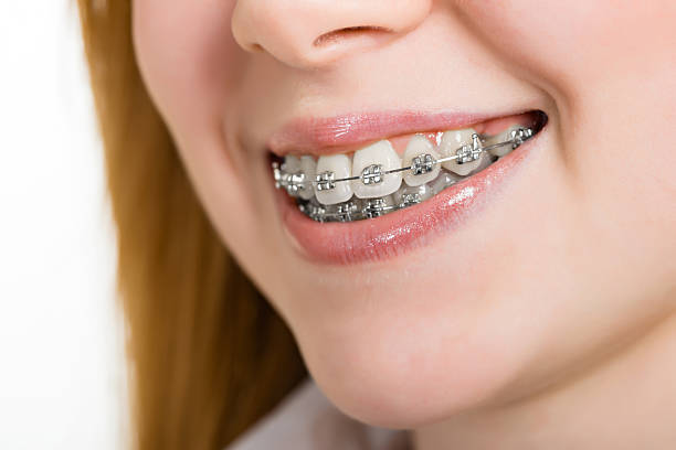 istock Beautiful young woman with brackets on teeth 474894037